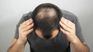 Male hair loss can have several causes, including genetic, hormonal, and lifestyle factors.